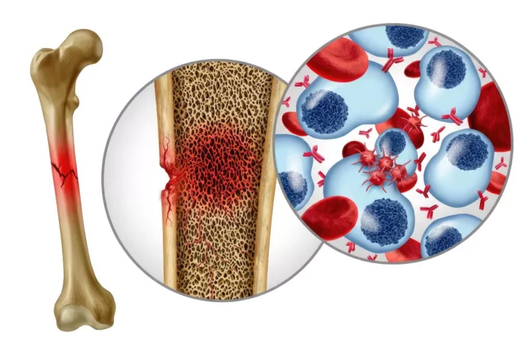 Bone Marrow Aspirations